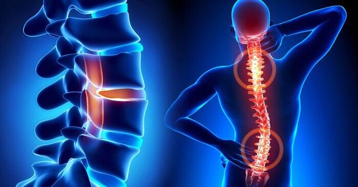 Lokalisierung von Schmerzen bei Osteochondrose