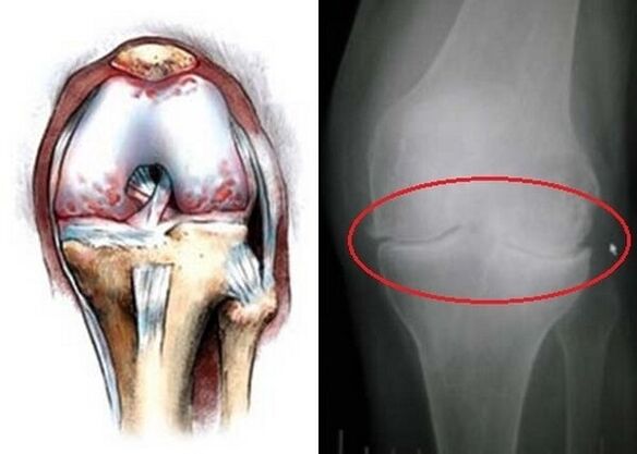 Arthrose des Kniegelenks